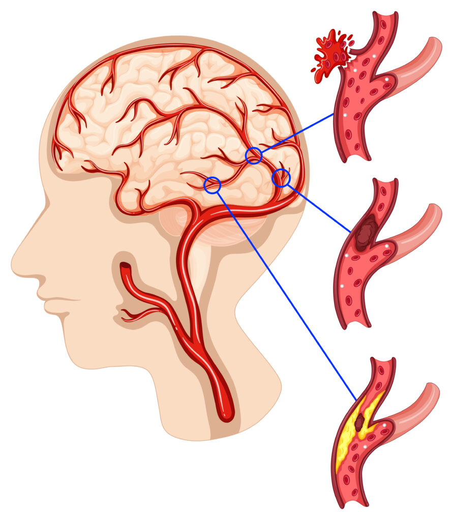 Cerebro-vascular diseases